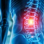 Arthrose